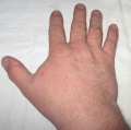 Geschwollene Hand.jpg