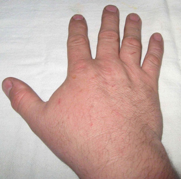 Datei:Geschwollene Hand.jpg
